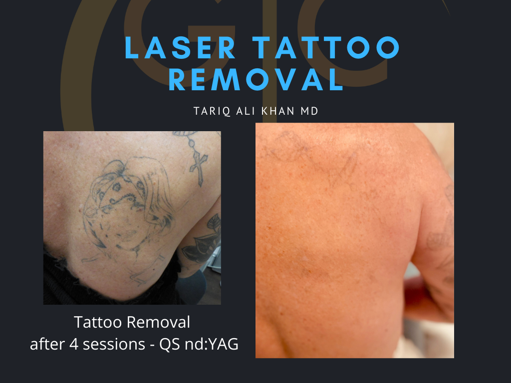 Gentle Care Laser Tustin Before and After picture - Tattoo Removal Mucosal Surface